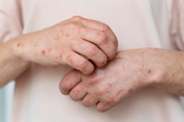 Confirman la primera muerte en 2026 por sarampión en México