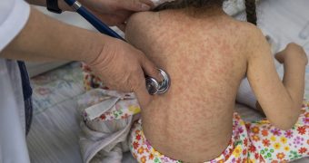 Nueva muerte por sarampión en México