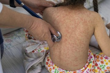 Nueva muerte por sarampión en México