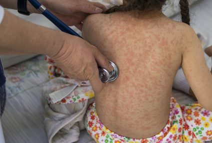 Nueva muerte por sarampión en México